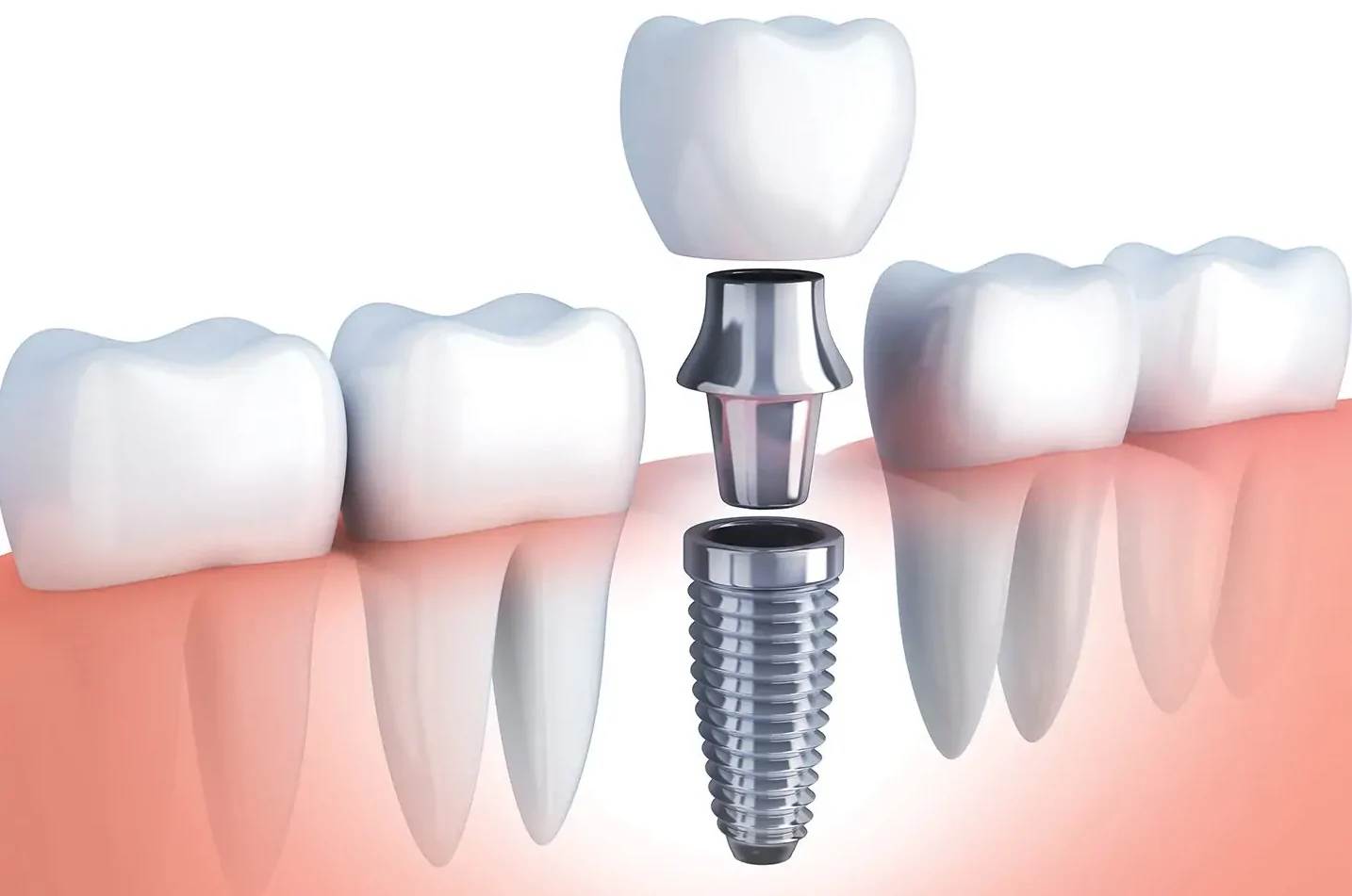 How Dental Implants Can Transform Your Smile: Insights from Sheffield